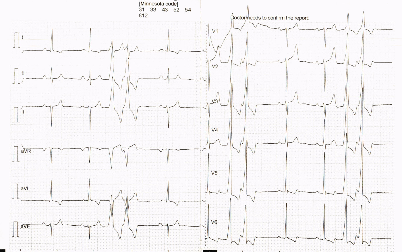 thangavel ecg sca004.jpg